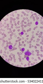 Chronic Lymphocytic  Leukemia  (CLL)