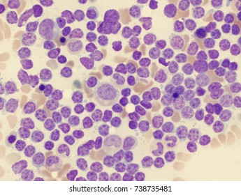 Chronic Lymphocytic Leukemia (CLL)