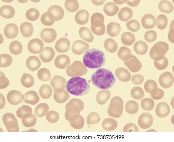 Chronic Lymphocytic Leukemia (CLL), B-cell Subtype