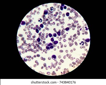 Chronic Lymphocytic Leukemia (CLL) Cells