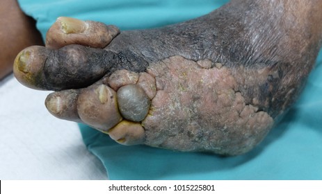 Chronic Lymphoedema Añd Scarring Of Left Diabetic Foot .