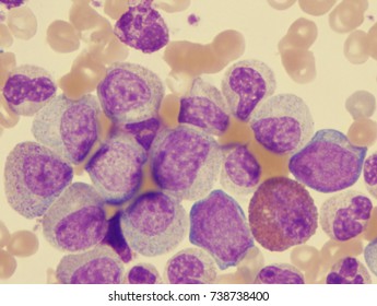 Chronic Myelocytic Leukemia (CML)