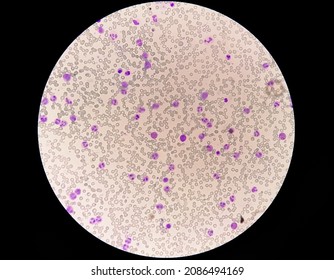 Chronic Myelocytic Leukemia (CML)  With Chronic Phase. Hematology. 