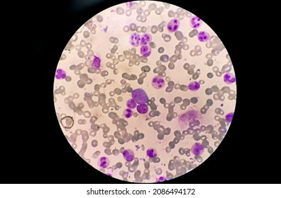 Chronic Myelocytic Leukemia (CML)  With Chronic Phase. Hematology. 