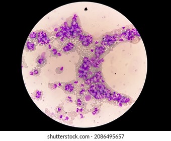 Chronic Myelocytic Leukemia (CML)  With Chronic Phase. Hematology. 