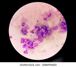 Chronic Myelocytic Leukemia (CML)  With Chronic Phase. Hematology. 