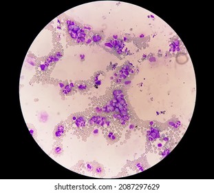 Chronic Myelocytic Leukemia (CML)  With Chronic Phase. Hematology. 