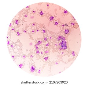 Chronic Myelocytic Leukemia (CML)  With Chronic Phase. Hematology.