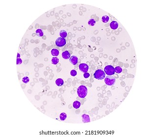 Chronic Myelocytic Leukemia (CML) With Chronic Phase. Hematology. 200x