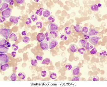 Chronic Myelogenous Leukemia (CML)