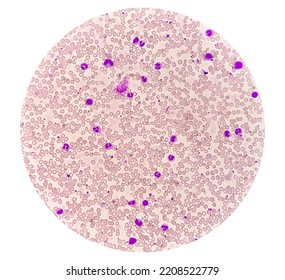 Chronic Myelogenous Leukemia Cml Known Chronic Stock Photo 2208522779 