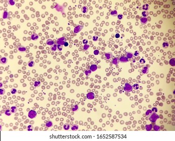 Chronic Myeloid Leukemia (CML). Red Blood Cell. Blood Smear