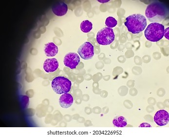 Chronic Myeloid Leukemia (CML). Red Blood Cell. Blood Smear