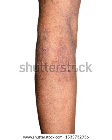 Chronic or recurrent contact dermatitis or allergic dermatitis in right forearm of Southeast Asian, adult man. Isolated on white background.