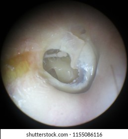 Chronic Suppurative Otitis Media. Subtotal Perforation Of The Tympanic Membrane