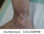 Chronic ulcer of the ankle