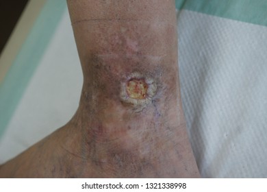Chronic ulcer of the ankle