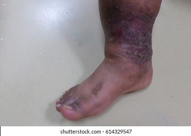 Chronic Venous Insufficiency With Lipodermatosclerosis. Inverted Beer Bottle Appearance