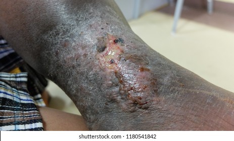 Chronic Venous Insufficiency With Varicose Ulcers