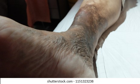 Chronic Venous Insufficiency With Varicose Veins And Hyperpigmented Lower Limb. 