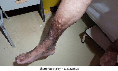 Chronic Venous Insufficiency With Varicose Veins And Hyperpigmented Lower Limb. 