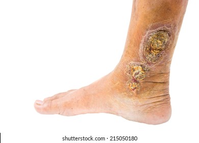 Chronic Venous Leg Ulcer