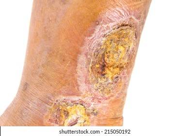 chronic venous leg ulcer
