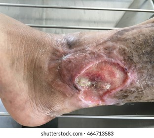 Chronic Venous Leg Ulcer