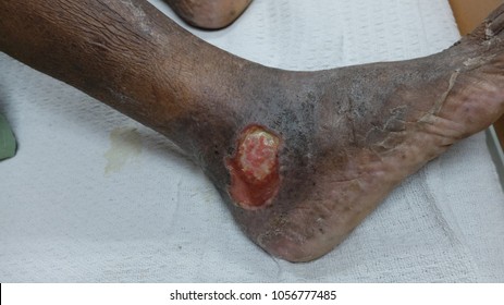 Chronic Venous Ulcer With Hyperpigmentation Of Lower One Third Of Leg.