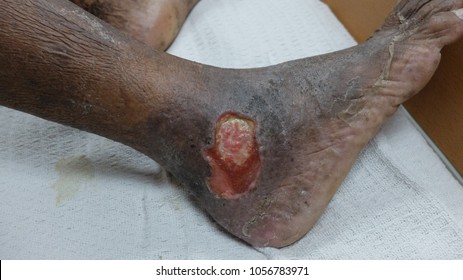 Chronic Venous Ulcer With Hyperpigmentation Of Lower One Third Of Leg.