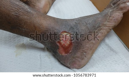 Chronic Venous Ulcer with Hyperpigmentation of lower one third of leg.