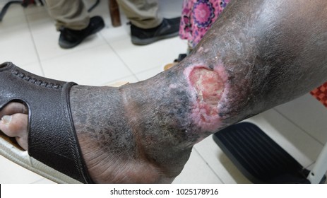 Chronic Venous Ulcer with lipodermatosclerosis and hyperpigmented skin of the lower limb. Disease caused by Chronic Deep Vein thrombosis and Venous Insufficiency.