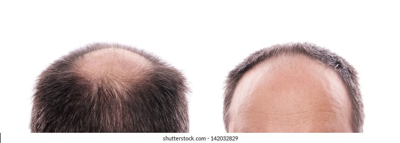 circular hair loss at the back of the head and receding hairline at the front