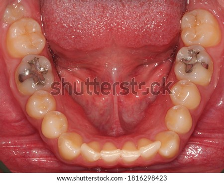 class one amalgams in great shape