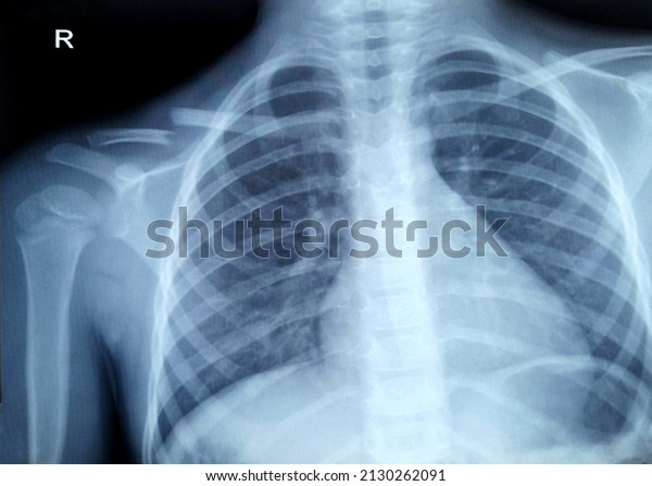 Clavicle fracture, complete closed\
fracture of the right clavicle with displacement,\
x-ray