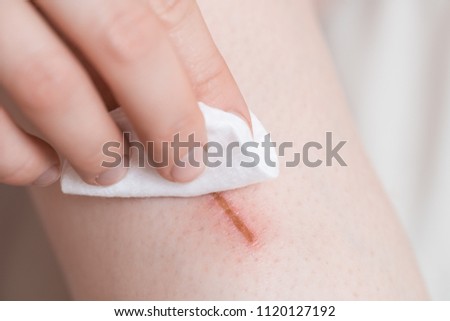 clean the wound on body with alcohol, first aid
