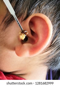 Cleaning A Child Ear Using Metal Earpick For Removing Wax