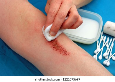 Cleaning Flesh Wound On A Leg With Antiseptic Liquid To Help Stop Infection.