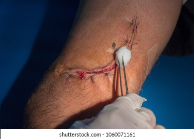 cleaning the suture wound at the leg.