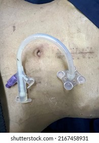 Cleaning Wounds On The Abdomen Percutaneous Endoscopic Gastrostomy