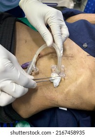 Cleaning Wounds On The Abdomen Percutaneous Endoscopic Gastrostomy