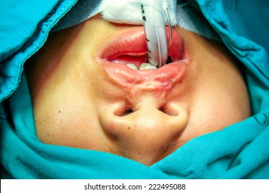 Cleft Lip And Palate Surgery.