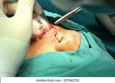 Cleft Lip And Palate Surgery.