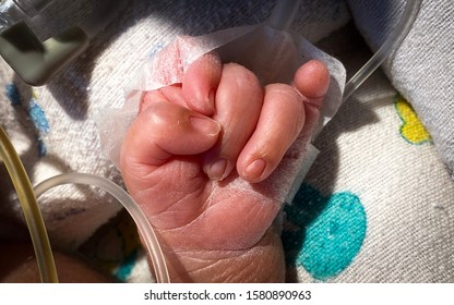 Clenched hand with overlapping fingers is characteristically seen in Edwards syndrome.