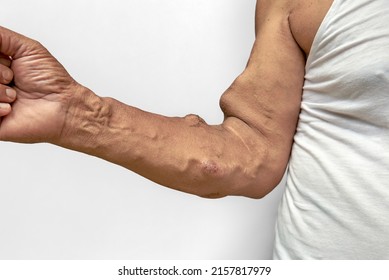 Clinical image in nephrology and dialysis: Arteriovenous fistula in the right forearm of hemodialysis patient that visibly raised,well distended,and aneurysmal on white background with clipping path.