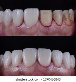 Clinical steps and sequence of ceramic veneer placing or install on discoloured teeth. Correction of severe discoloured teeth with white veneers.