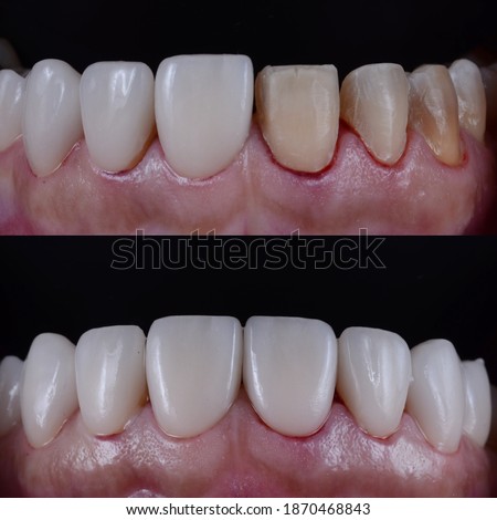 Clinical steps and sequence of ceramic veneer placing or install on discoloured teeth. Correction of severe discoloured teeth with white veneers.