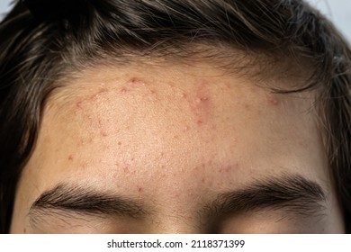 Close up Acne and blackhead pimples skin rash on teenage boy's forehead. Face skin problem concept.