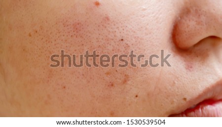 close up of acne on the woman face