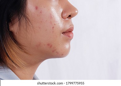 Close Up Acne Skin Caused By Hormone,Oily Face In Woman Face. Right Side